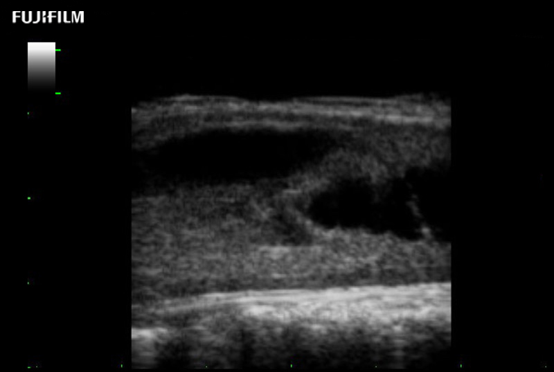 Spinal Cord Complex Tumor of Thoracic Spinal Cord