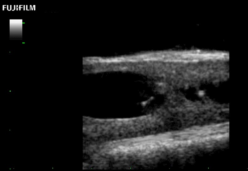 Spinal Cord Complex Tumor of Thoracic Spinal Cord