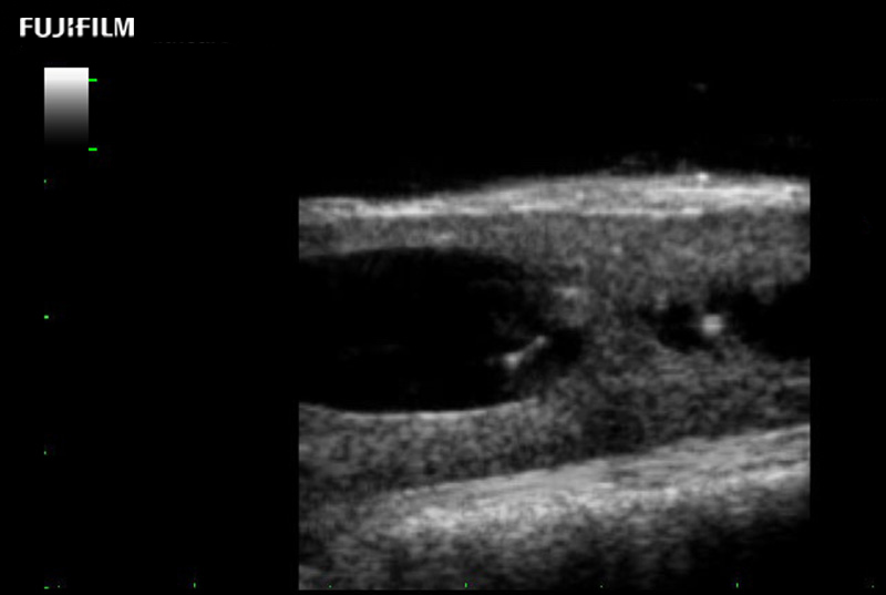 Spinal Cord Complex Tumor of Thoracic Spinal Cord