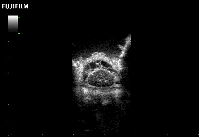 Spinal Cord Transverse View Sub Arachnoid Space