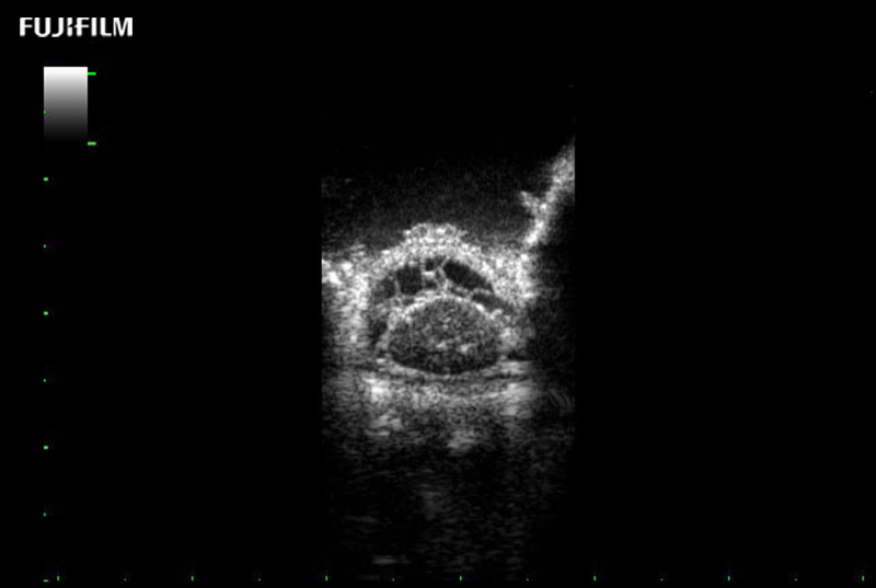 Spinal Cord Transverse View Sub Arachnoid Space