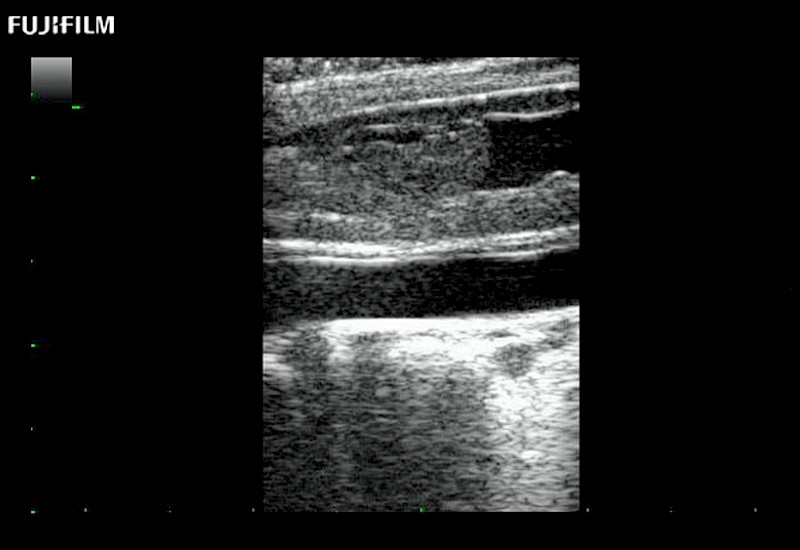 Spinal Cord Tumor