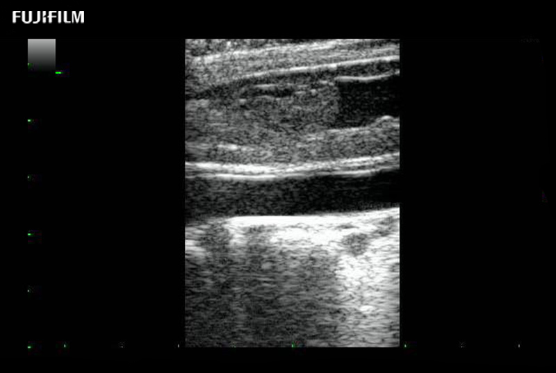 Spinal Cord Tumor