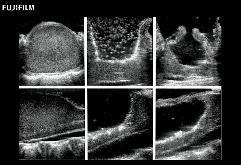 Pediatric Spinal Cord Tumor Sequence