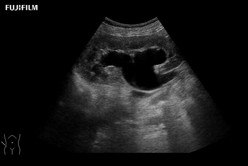 Kidney Hydronephrosis