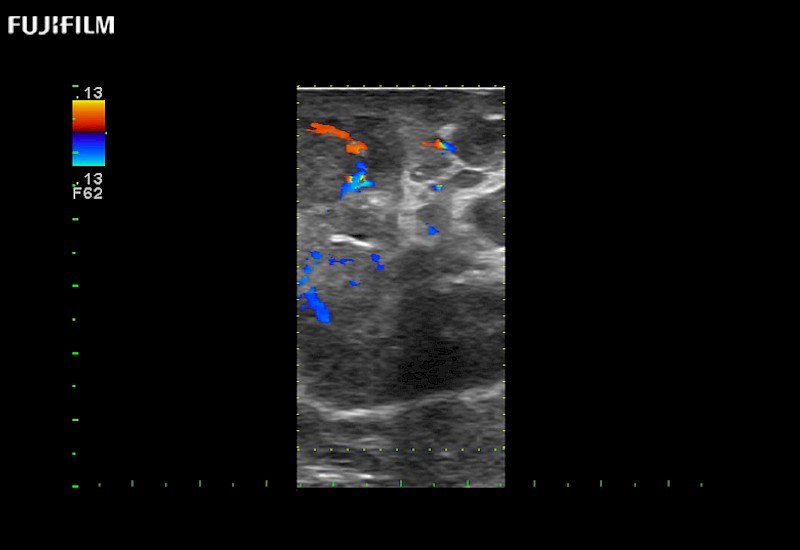 RAPN with Color Doppler