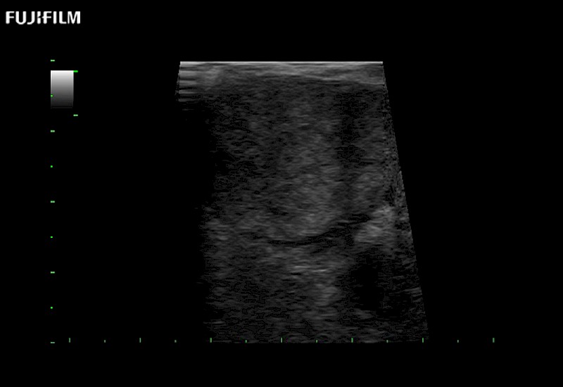 RAPN with Trapezoid Imaging