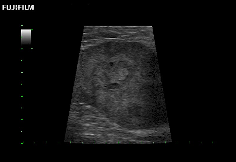 RAPN with Trapezoid Imaging