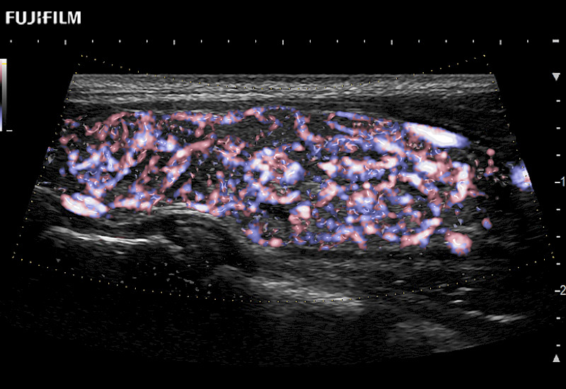 Thyroid EFlowGlossyTrapezoid 10