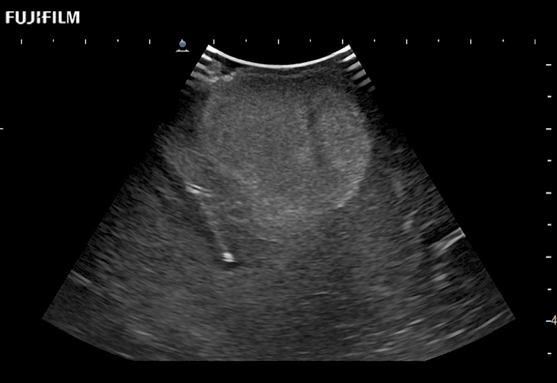 Cranial Tumor 1