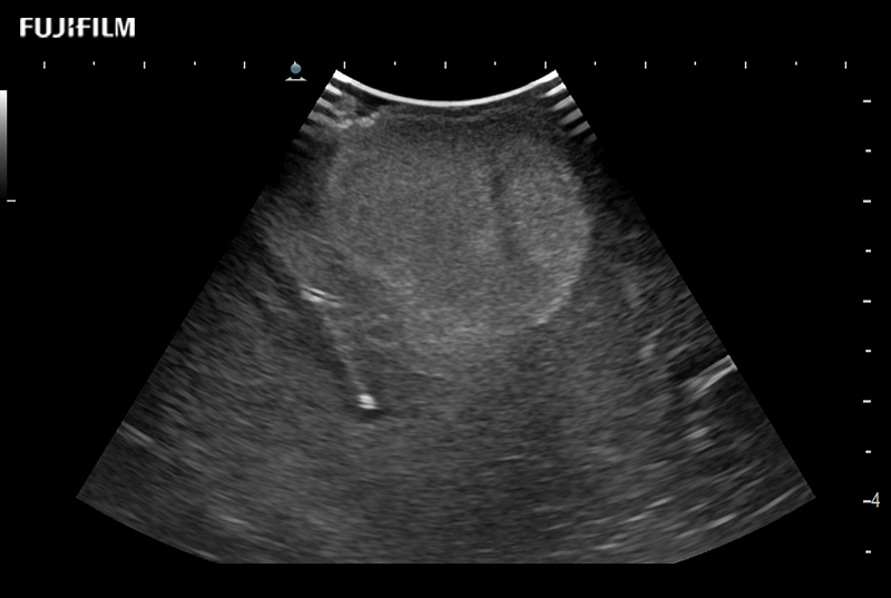 Cranial Tumor 1