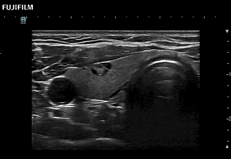 Thyroid Nodule