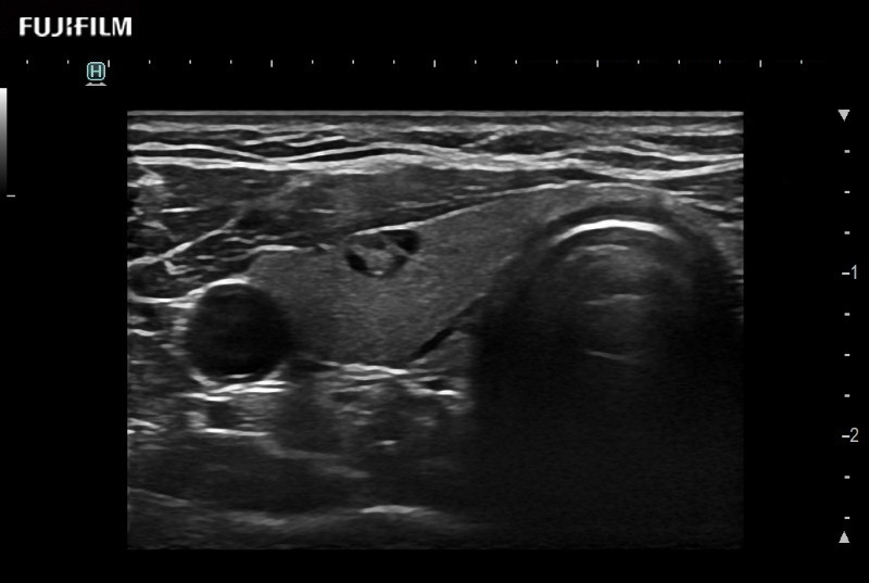 Thyroid Nodule