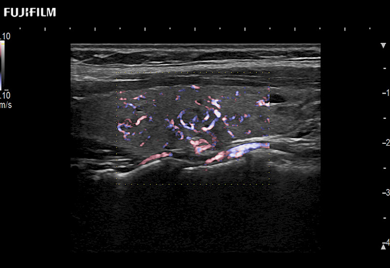 Thyroid eFlow 8