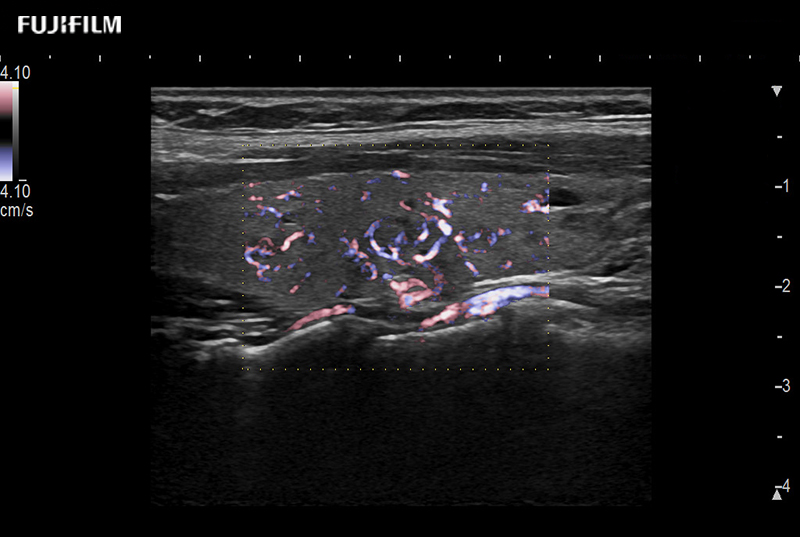 Thyroid eFlow 8