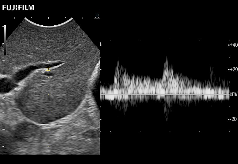 Liver Doppler 9