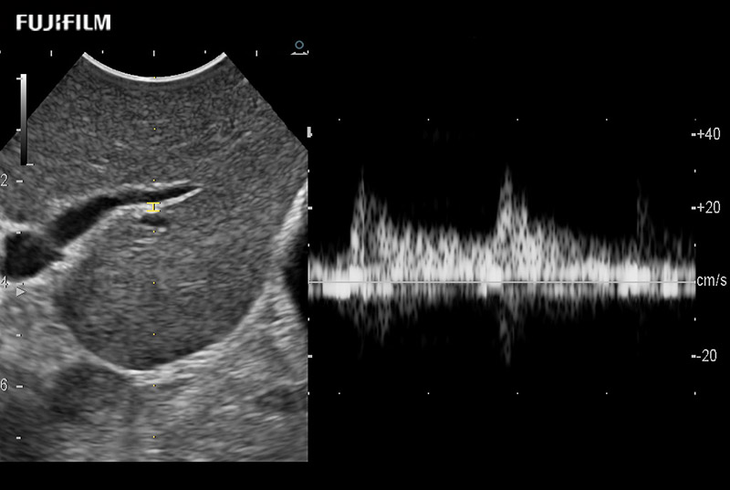 Liver Doppler 9