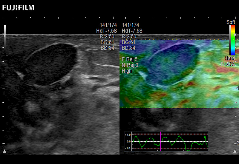 Breast Nodule Elastog 8