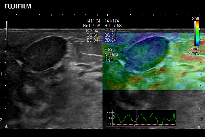 Breast Nodule Elastog 8