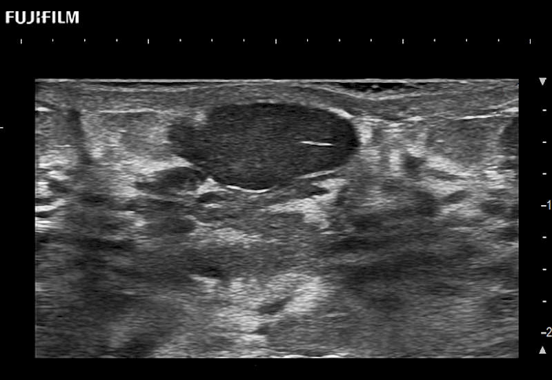 Breast Nodule SCITHI 9