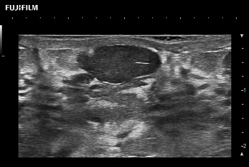 Breast Nodule SCITHI 9