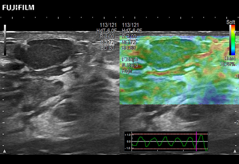 Breast Nodule Elasto 8