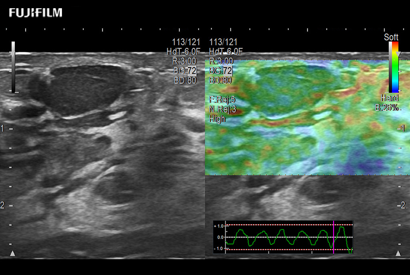 Breast Nodule Elasto 8