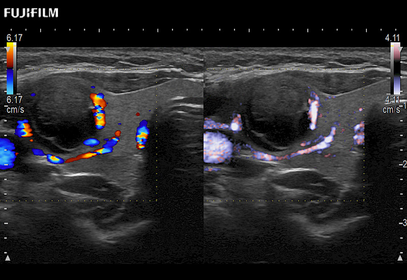 Thyroid Nodule DualColorEflow 10