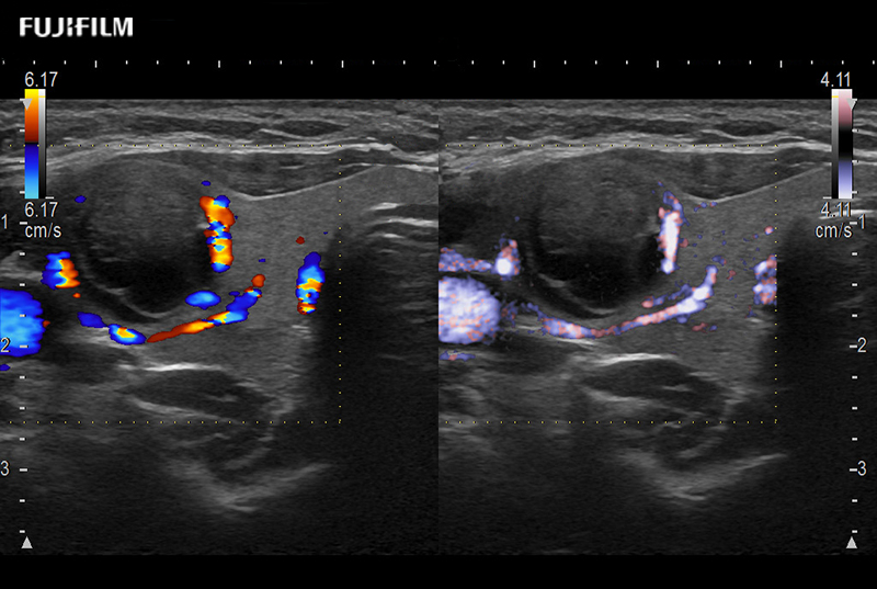 Thyroid Nodule DualColorEflow 10