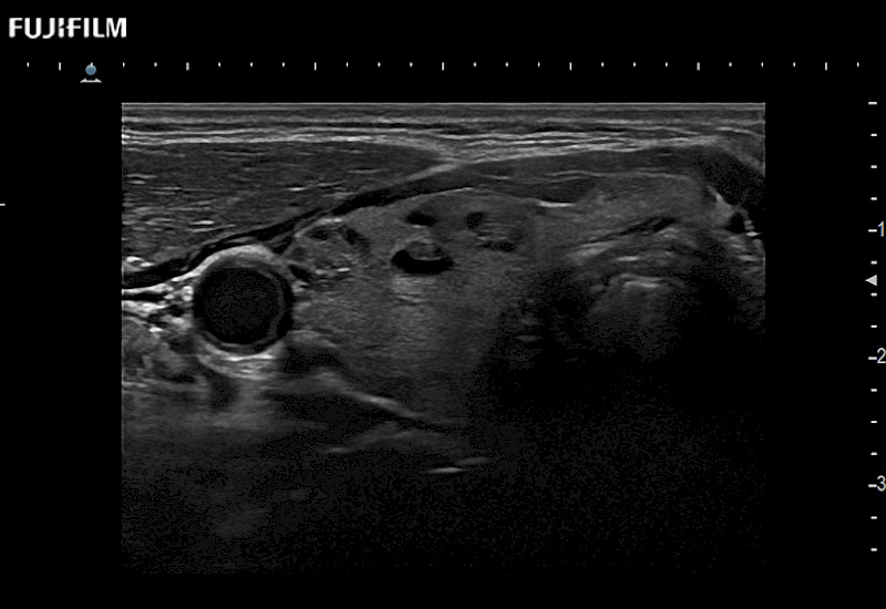 Thyroid Lesions 9