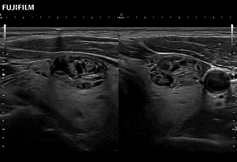 Thyroid Lesions Dual 9