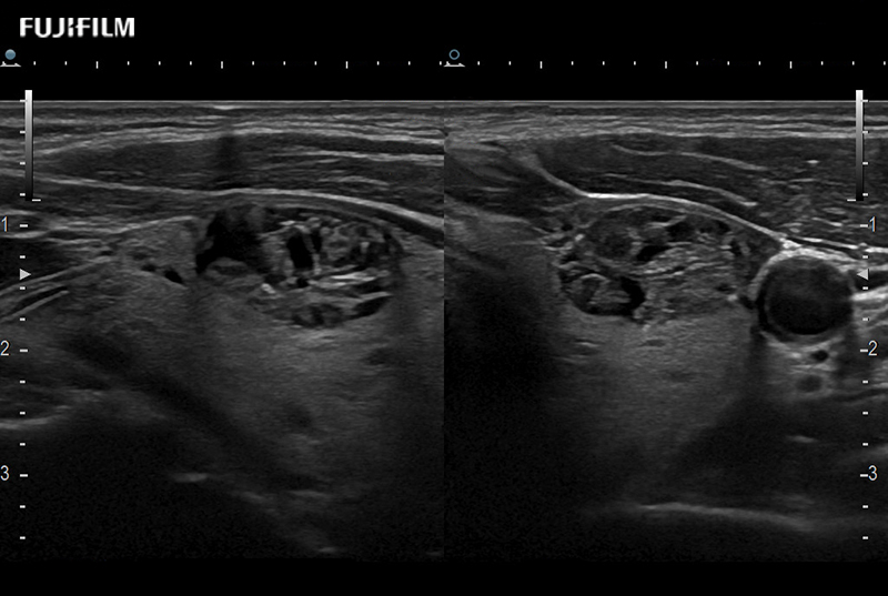 Thyroid Lesions Dual 9