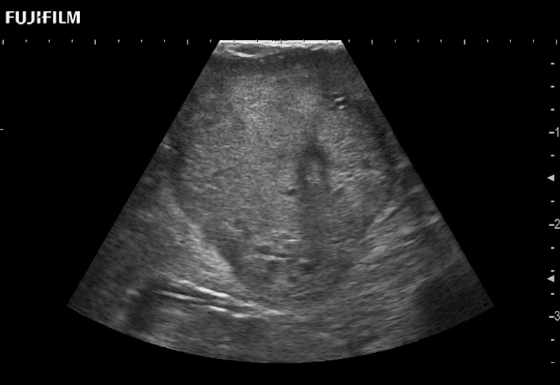 L51K Partial Nephrectomy Tumor