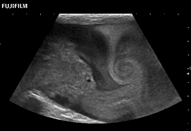 L51K IVC Thrombus