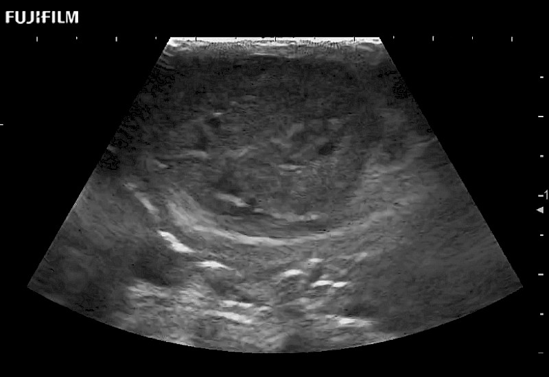 L51K IVC Thrombus