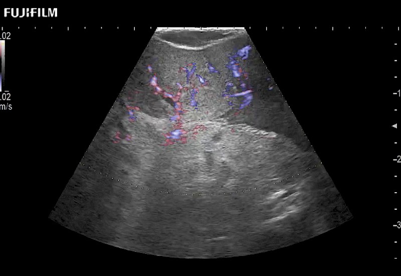 L51K Partial Nephrectomy eFlow