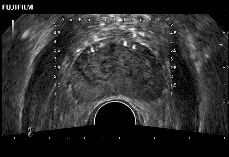 Prostate Brachy with Seeds