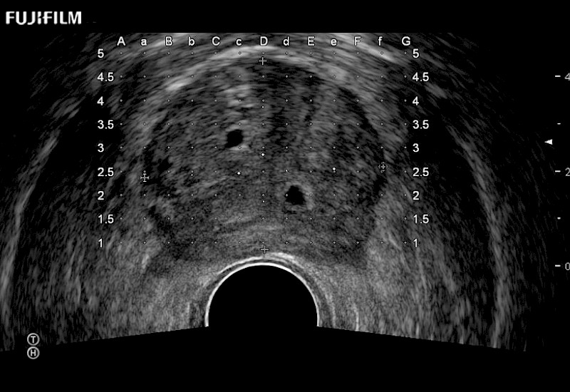 Prostate Cysts