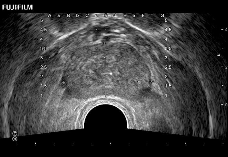 Prostate Grid