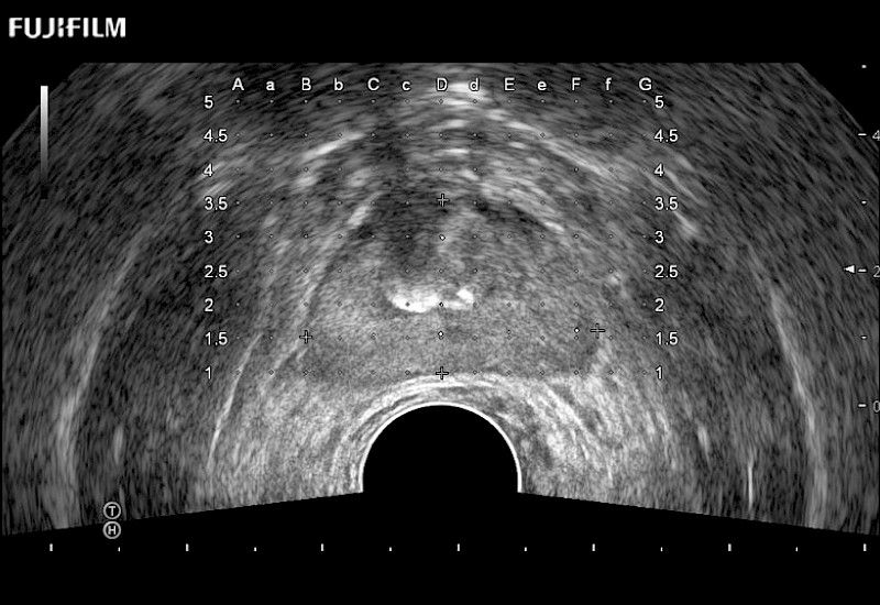 Prostate Grid Calcification