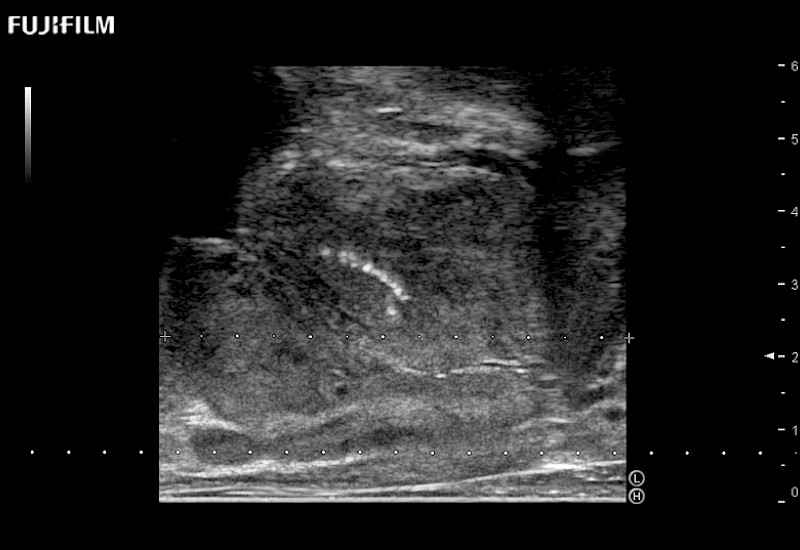 Prostate Calcification