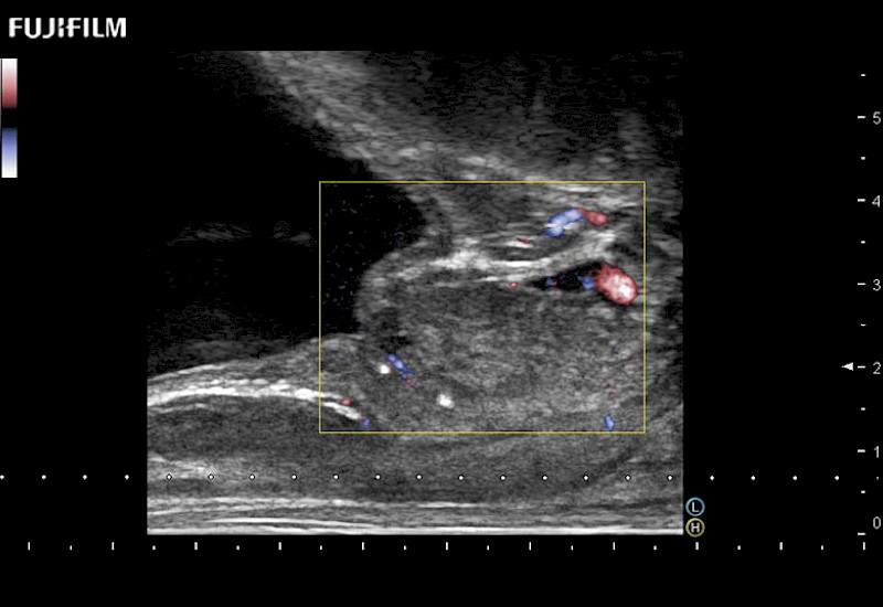 Prostate with Color Doppler