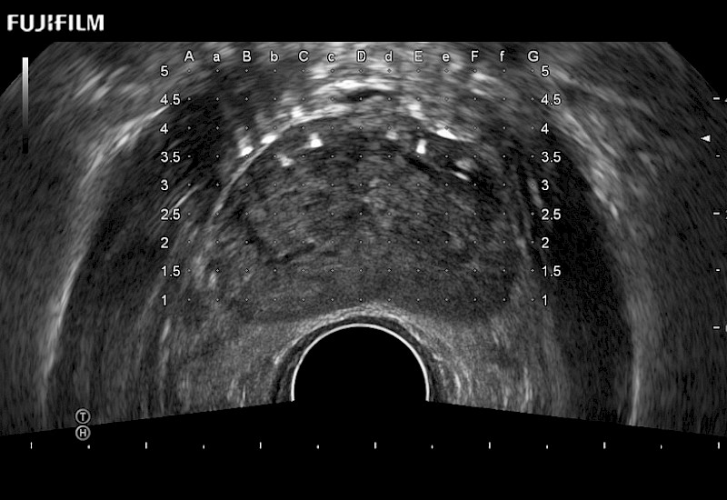 Prostate Brachy with Seeds