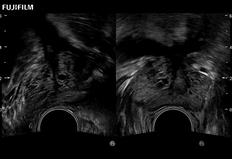 Prostate Dual Screen