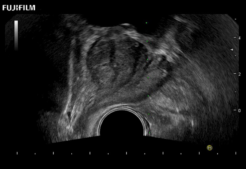 Urology Prostate Biopsy