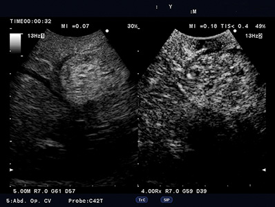 Contrast Harmonic Imaging (CHI)