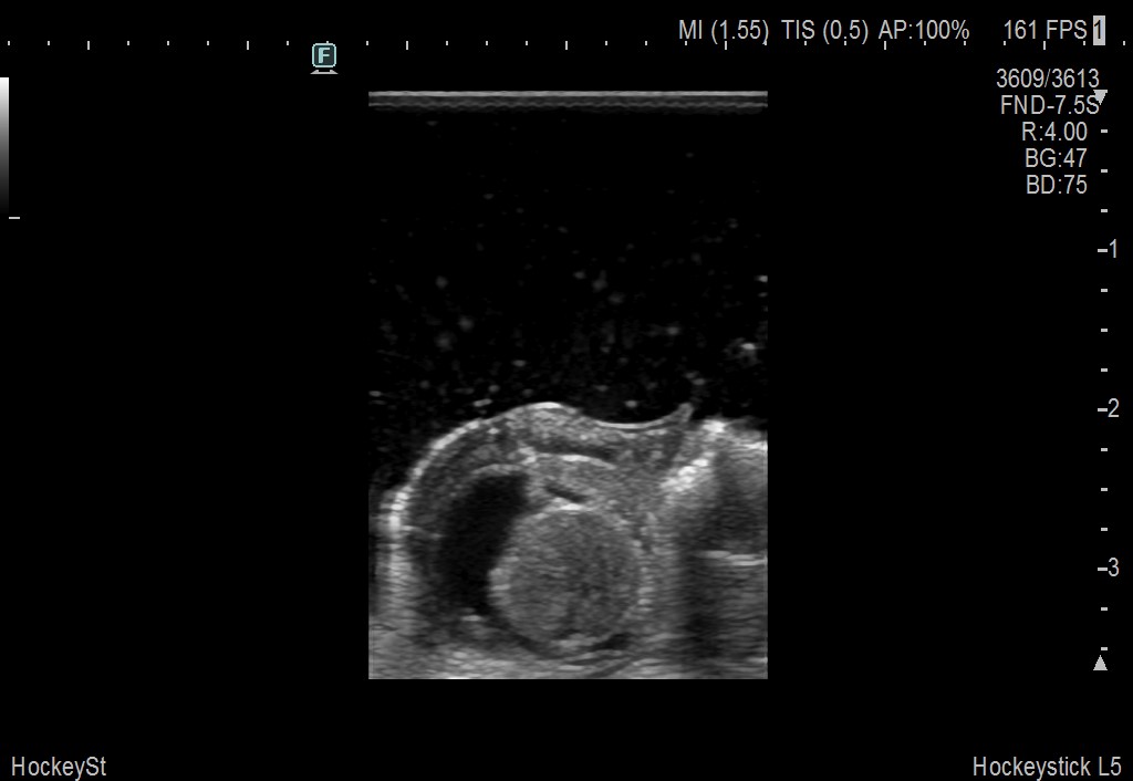 Spinal Procedure using L53K