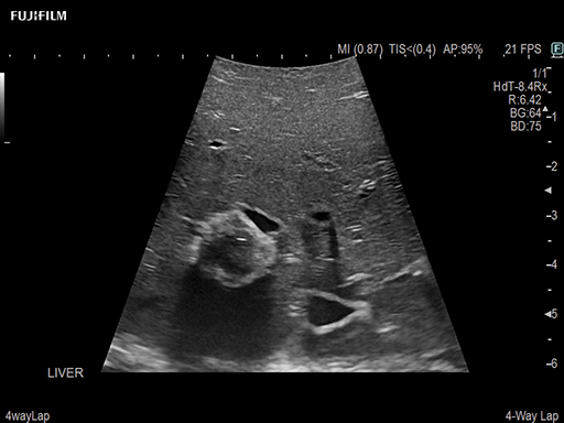 Laparoscopic Partial Nephrectomy & Hepatectomy using C9150LA
