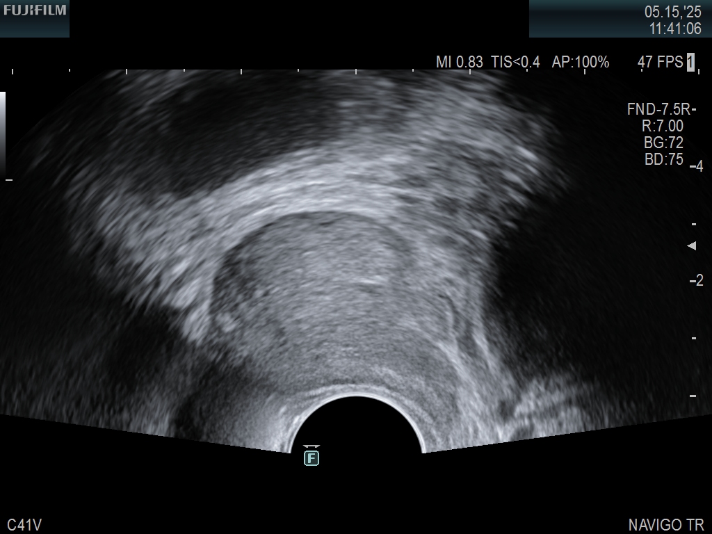 Prostate imaging using the C41V Transducer