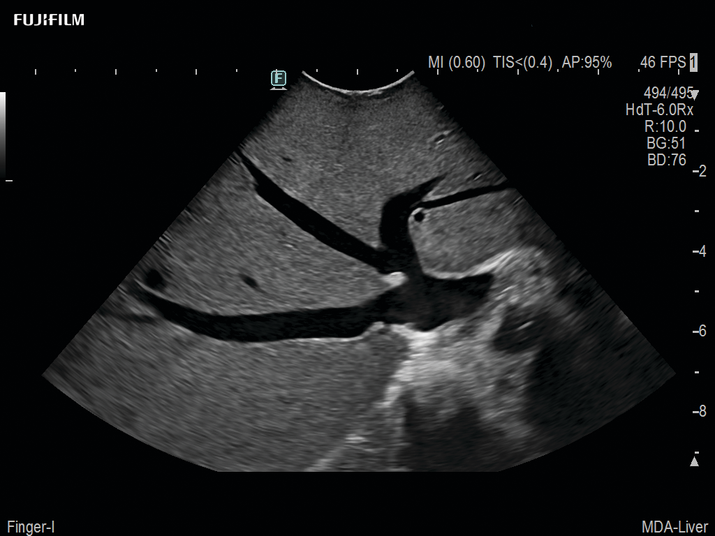 Liver Surgery Procedure using C22I